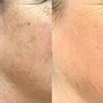 Brown Spot Laser Treatment