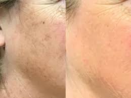 Brown Spot Laser Treatment