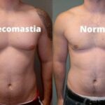 Male breast reduction in Islamabad