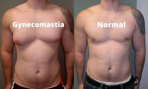 Male breast reduction in Islamabad