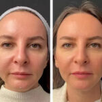 Best Doctors in Dubai for Mesotherapy: Top Experts to Trust