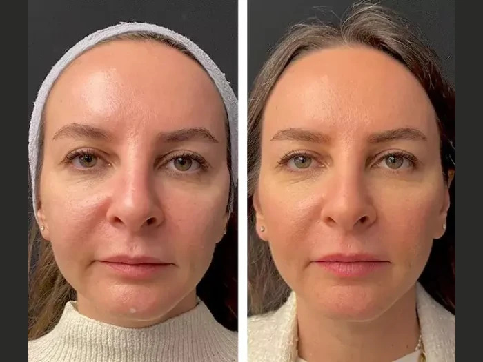 Best Doctors in Dubai for Mesotherapy: Top Experts to Trust