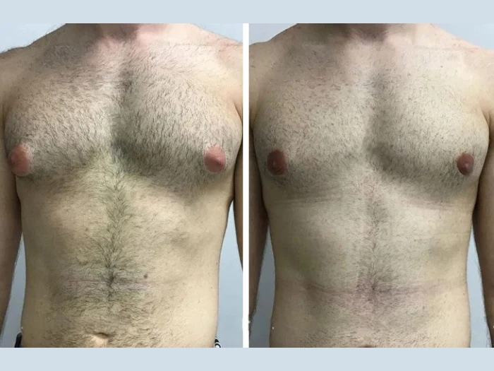 Top Cosmetic Clinics Offering Gynecomastia in Dubai
