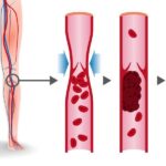 dvt symptoms
