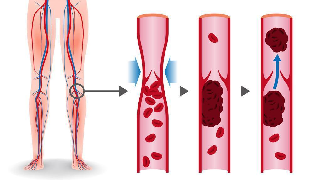 dvt symptoms