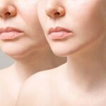 Are Dermal Fillers in Oahu the Secret to Youthful Skin?