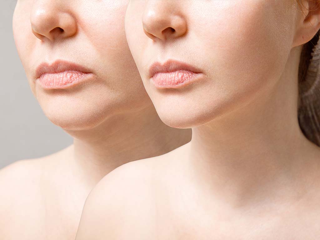 Are Dermal Fillers in Oahu the Secret to Youthful Skin?