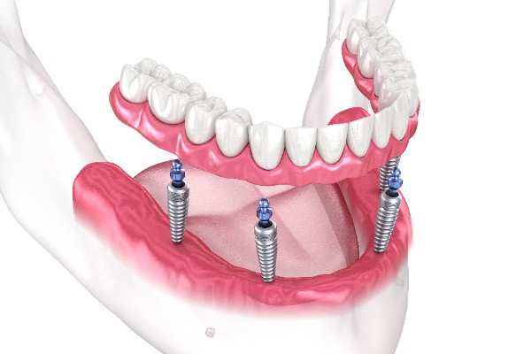 Dental implants Blackburn