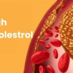 High-Cholestrol