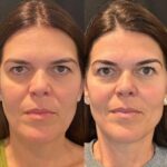 Thread Lift Delivers Non Surgical Beauty Results from the Best Doctors in Dubai