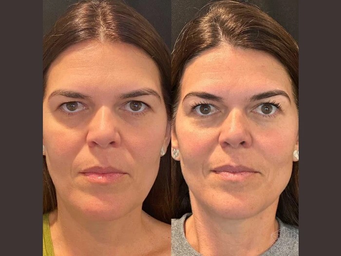 Thread Lift Delivers Non Surgical Beauty Results from the Best Doctors in Dubai