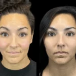 How the Best Doctors in dubai Customize Botox Treatments for Every Face
