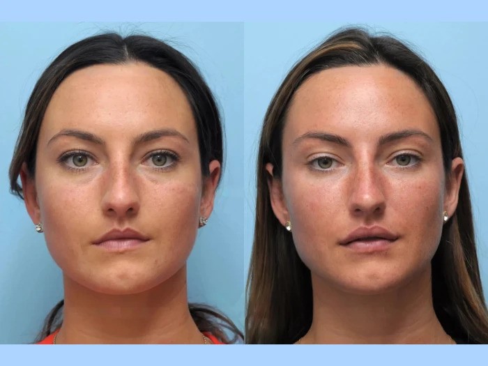 Best Doctors in Dubai Suggest Thread Lift for Radiant Younger Skin Instantly
