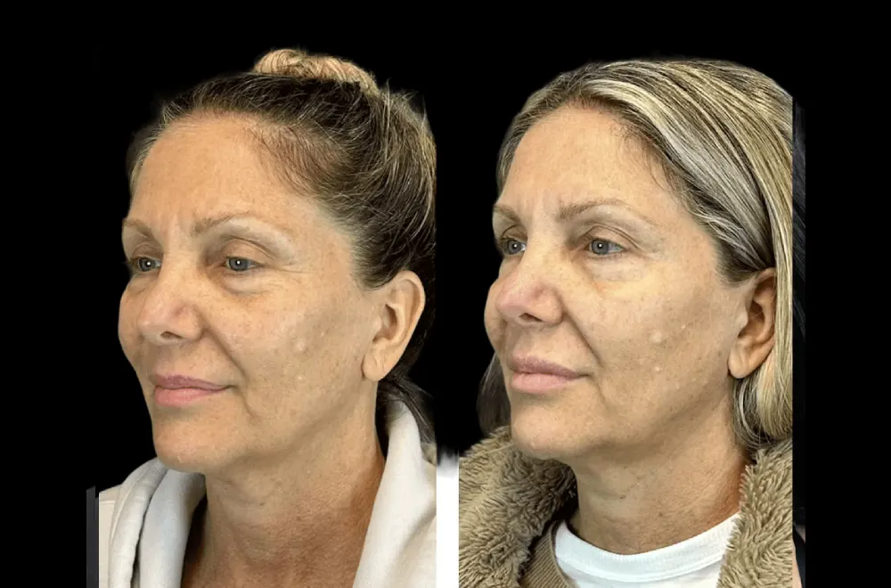 Best Aesthetic Clinics in dubai Offering Personalized Botox Plans