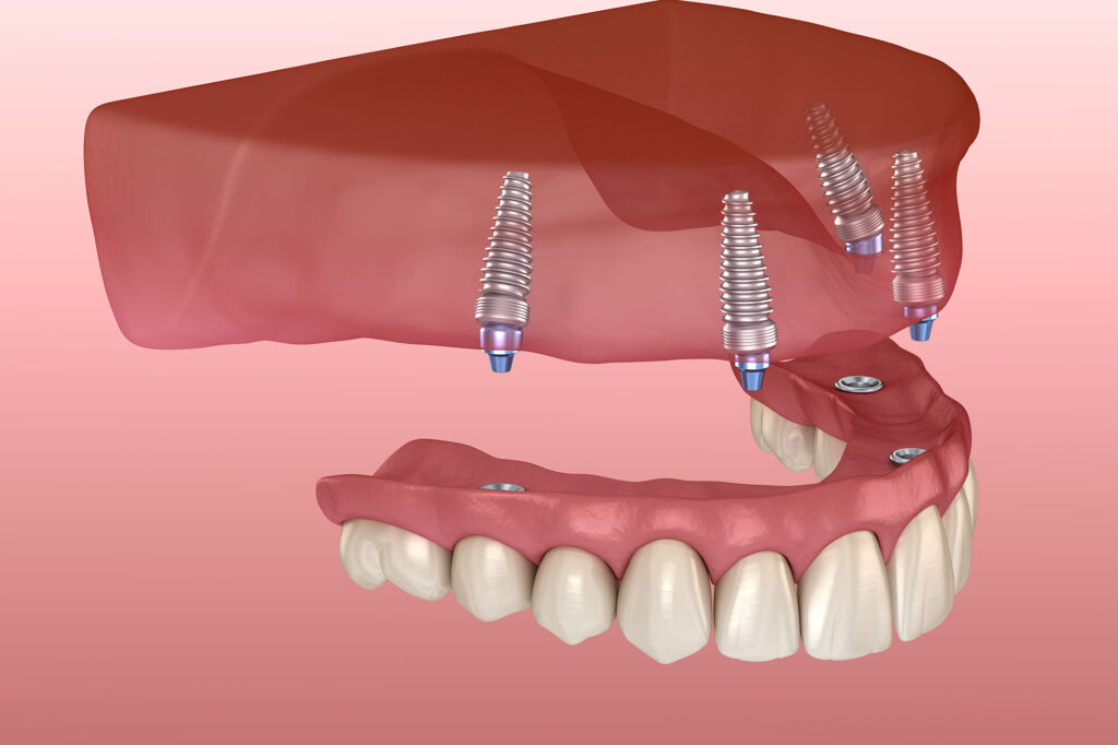 Explore denture dentistry in Nampa ID for lasting results. Find affordable denture implants in Nampa ID for a natural, confident smile.