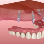 Explore denture dentistry in Nampa ID for lasting results. Find affordable denture implants in Nampa ID for a natural, confident smile.