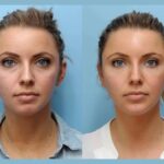 Rejuvenate Your Face Using Thread Lift from Best Doctors in Dubai