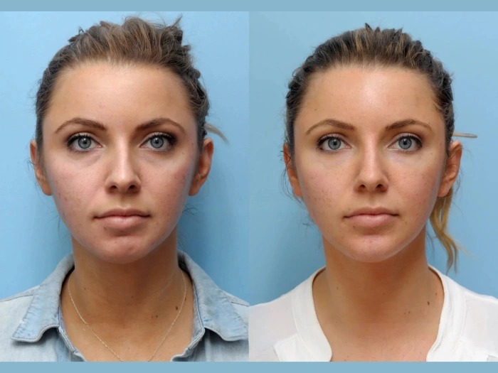 Rejuvenate Your Face Using Thread Lift from Best Doctors in Dubai