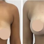 Comprehensive Guide to the Best Breast Reduction Surgeons in dubai