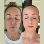 Experience the Magic of Fotona 4D Laser Skin Tightening in Dubai