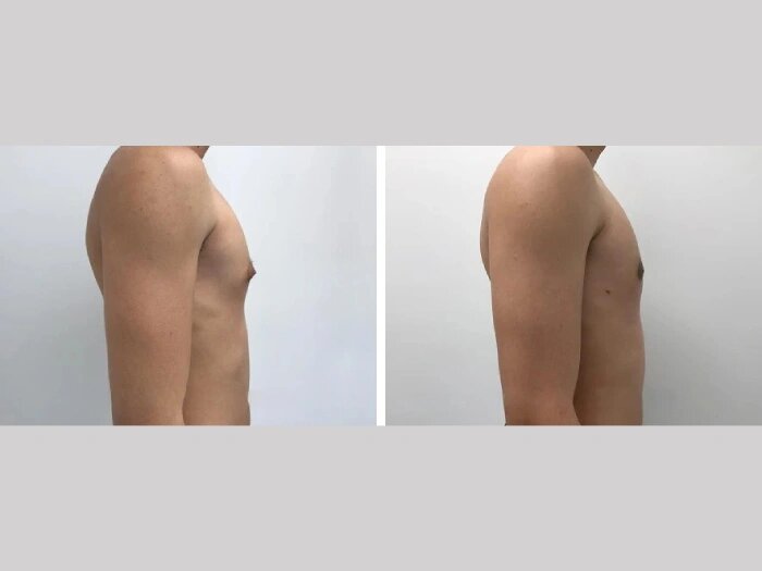 A Complete Guide to Gynecomastia in Dubai: From Diagnosis to Recovery