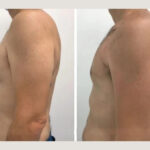 Best Gynecomastia Surgeons in dubai: Excellence in Every Chest Contour