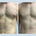 Best Gynecomastia Surgeons in dubai: Redefining Men’s Confidence
