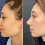 Fat Grafting in Dubai