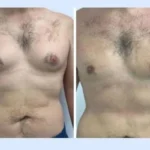 How Long Results Last with the Best Gynecomastia Surgeons in Dubai