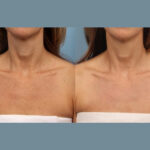 The Science of Smooth Skin with Moxi Laser Treatment in Dubai