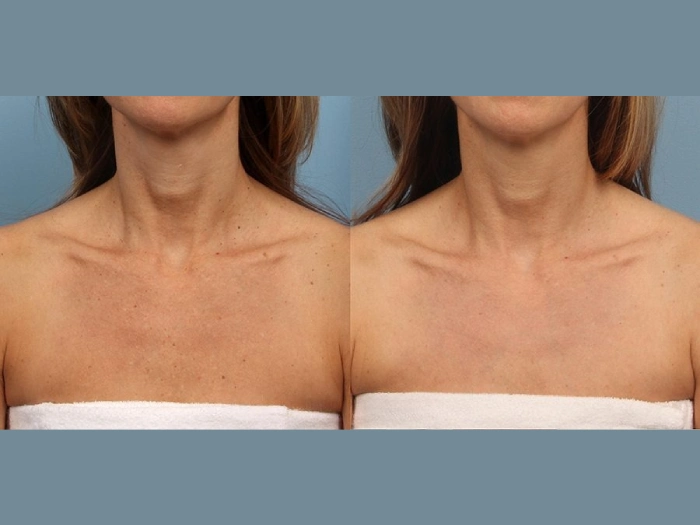 Discover the Power of Moxi Laser Treatment at the Hands of the Best Plastic Surgeon in Dubai