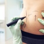The Science Behind a Perfect Tummy Tuck in Dubai