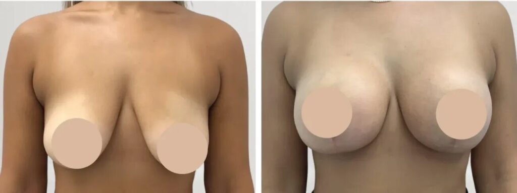 Best Doctors in Dubai Making Breast Reduction Safe & Effective