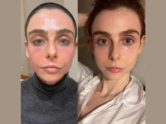 Younger-Looking Skin with Best Aesthetic Clinics in dubai Radiofrequency (RF) Microneedling