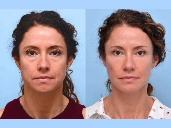 The Benefits of Thread Lift Treatments in Dubai for Skin Tightening