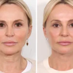 Restore Facial Harmony Naturally Using the Innovative Thread Lift Procedure by Best Plastic Surgeons in Dubai