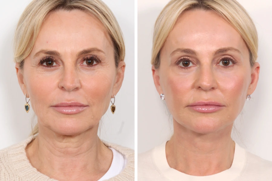 Restore Facial Harmony Naturally Using the Innovative Thread Lift Procedure by Best Plastic Surgeons in Dubai