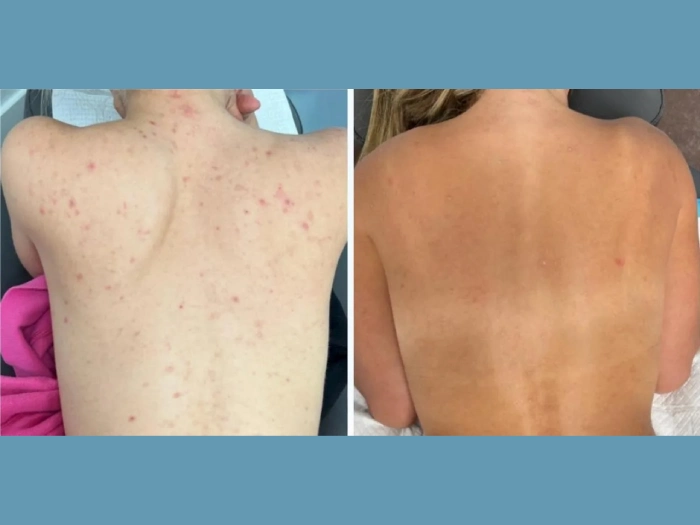 Rejuvenation Perfected by the Best Plastic Surgeon in Dubai with Moxi Laser Treatment