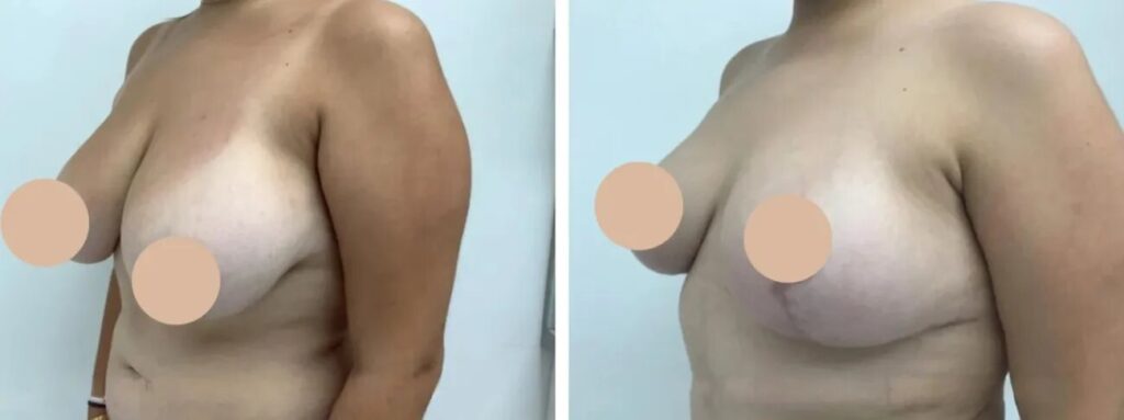 Elevating Beauty Standards with Breast Lift in Dubai and the Best Doctors in Dubai
