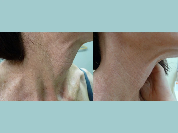 Precision and Perfection: Fotona 4D Laser in Dubai with the Best Plastic Surgeon in Dubai