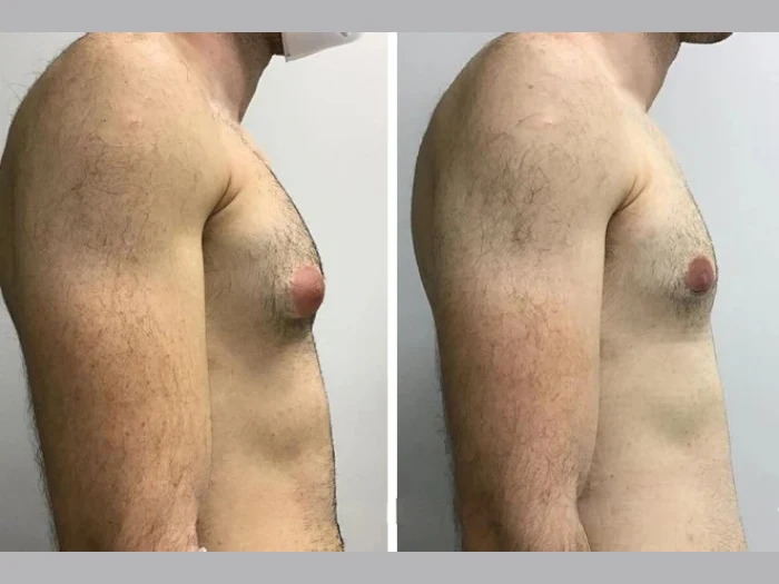 Best Gynecomastia Doctors in Dubai Renowned for Safe Surgical Practices