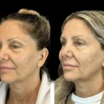 Why Choosing the Best Plastic Surgeon in Dubai Matters for First-Time Botox Users