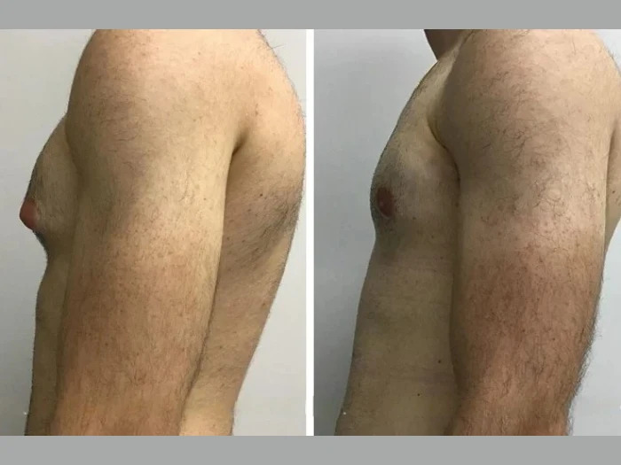 Redefine Your Body with Safe Gynecomastia Surgery in dubai