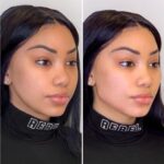 Why Women Prefer Thread Lift Treatment in Dubai for Natural Results