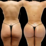 Butt Fat Transfer in Dubai: Enhancing Your Curves Naturally