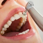 dental cleaning take