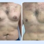 Best Gynecomastia Surgeons in dubai: Confidence Through Contouring