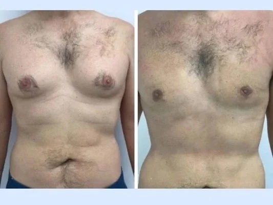 Why the Best Gynecomastia Surgeon in Dubai Focuses on High-Definition Chest Sculpting