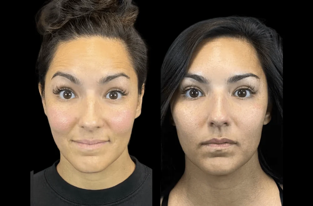 The Rise of Micro-Botox: Insights from the Best Plastic Surgeon in Dubai