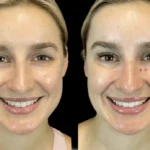 How the Best Doctors in Dubai Customize Botox for Every Age